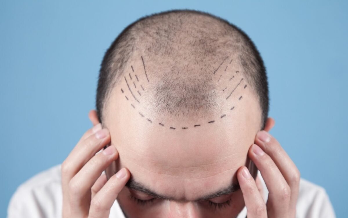 Hair Transplant Clinic Nanded