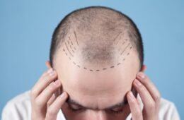 Hair Transplant in Nanded: Cost, Procedure, Best Clinic & Results
