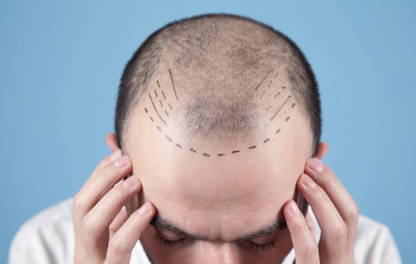Hair Transplant Clinic Nanded