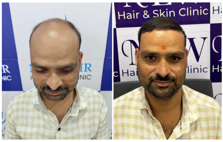 Hair transplant in nanded