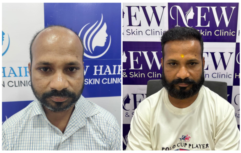 hair transplant result