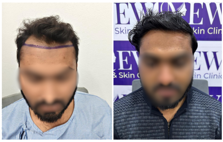 hair transplant in nanded