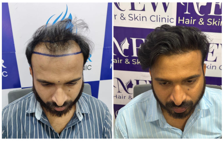 hair transplant in nanded