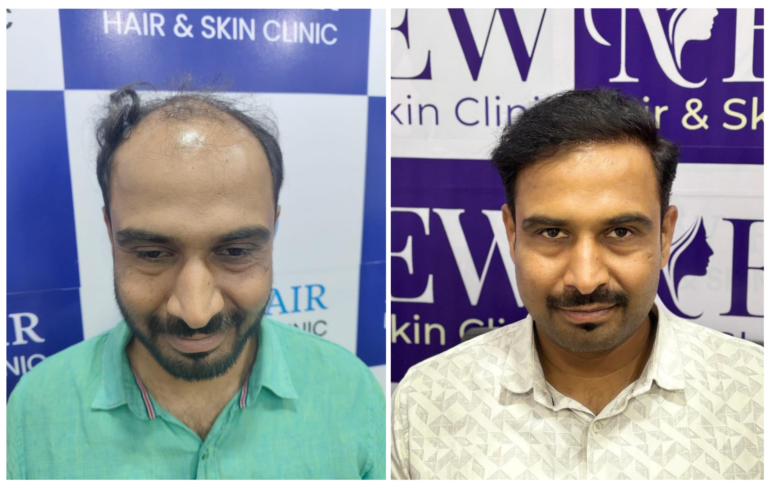hair transplant in nanded