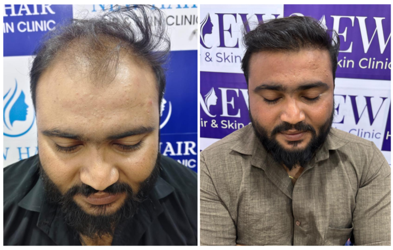 hair transplant in nanded