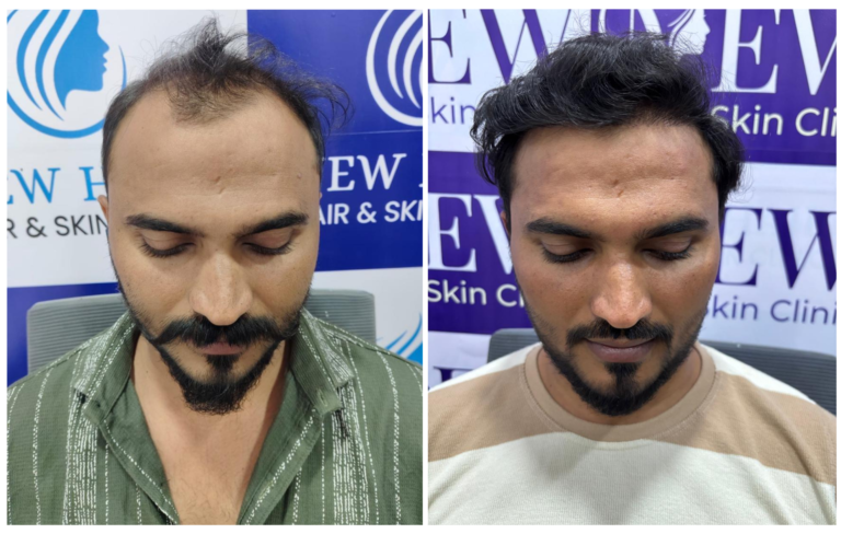 hair transplant in nanded