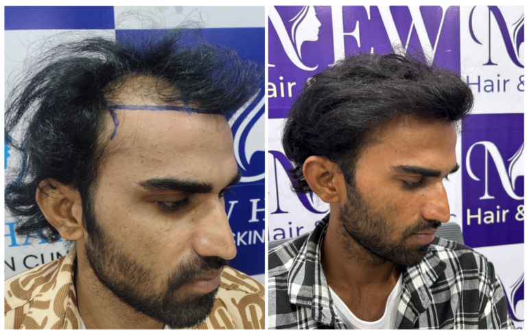 hair transplant in nanded