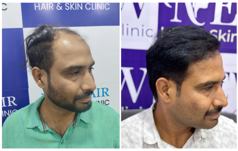 hair transplant in nanded