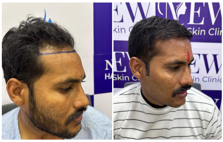 hair transplant in nanded