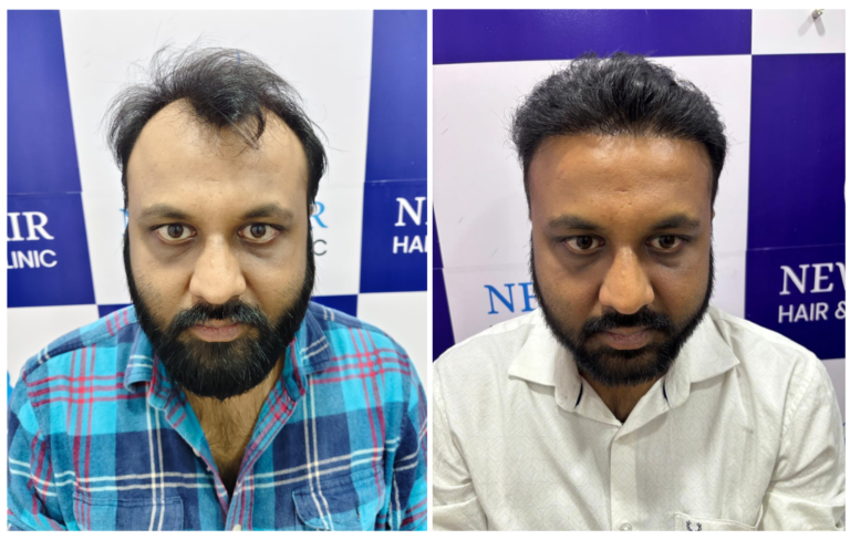 hair transplant result