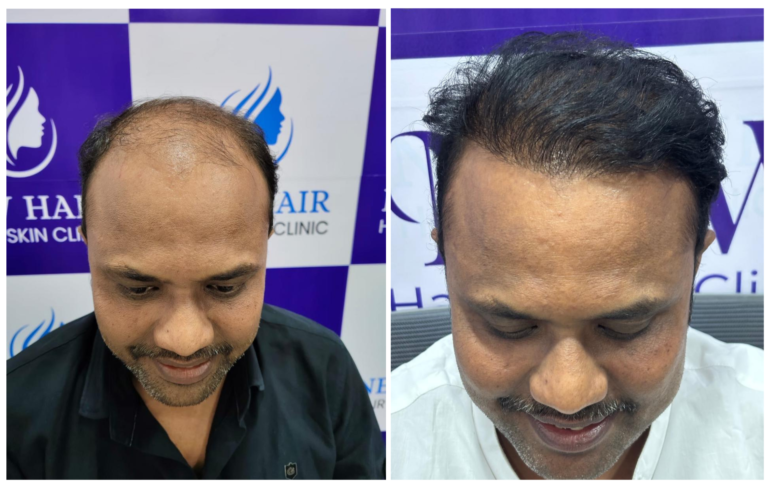 hair transplant in nanded