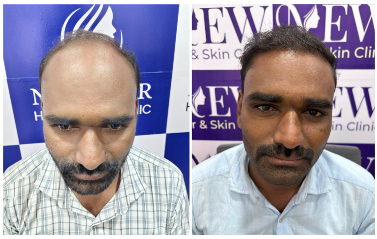 hair transplant in nanded
