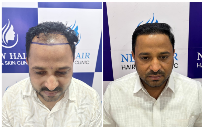Hair transplant in nanded