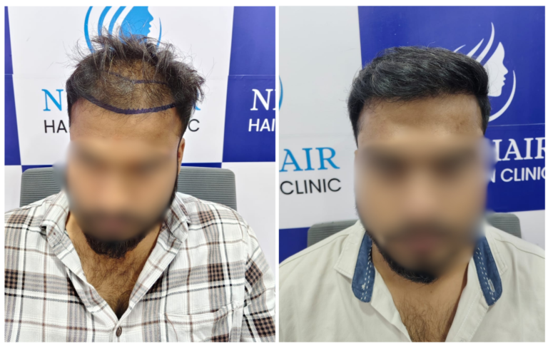 hair transplant result