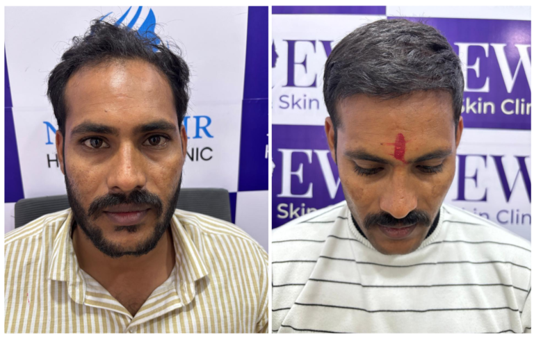 hair transplant in nanded