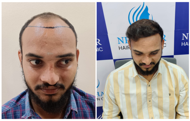 Hair transplant in nanded