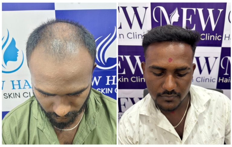 Hair transplant in nanded