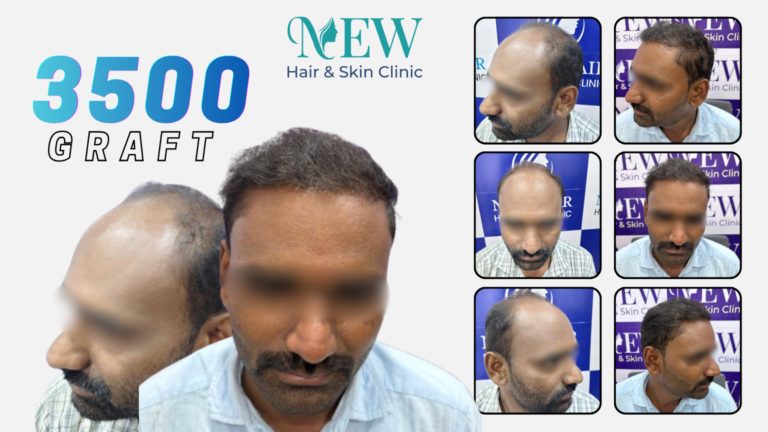 Hair Transplant