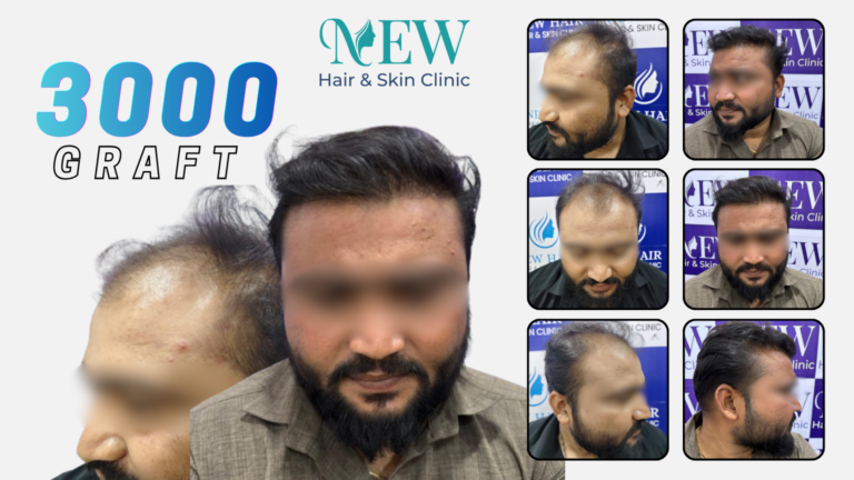 hair transplant
