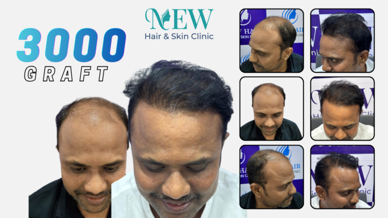 Hair Transplant