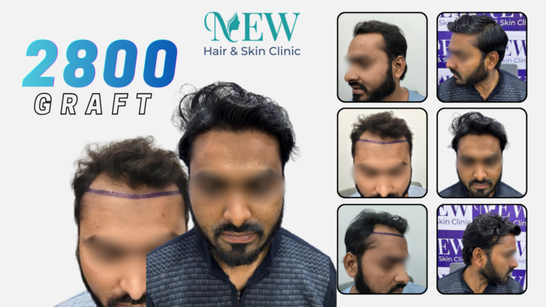 Hair Transplant