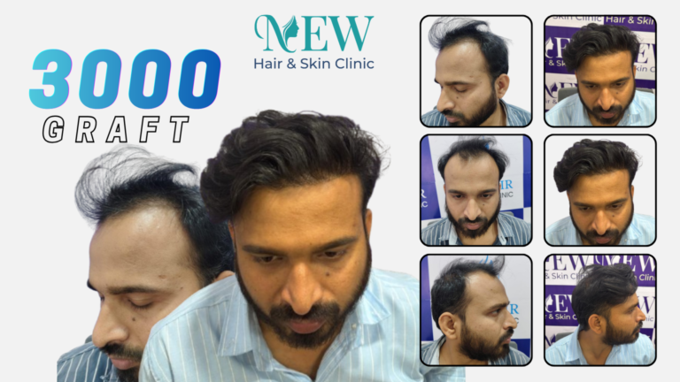 Hair Transplant
