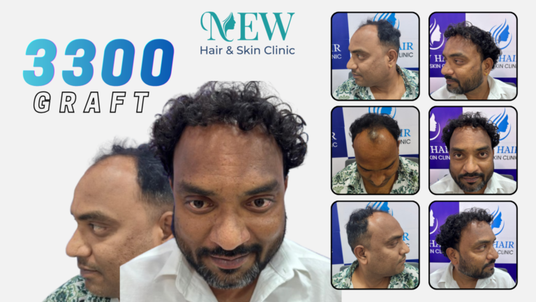 Hair Transplant