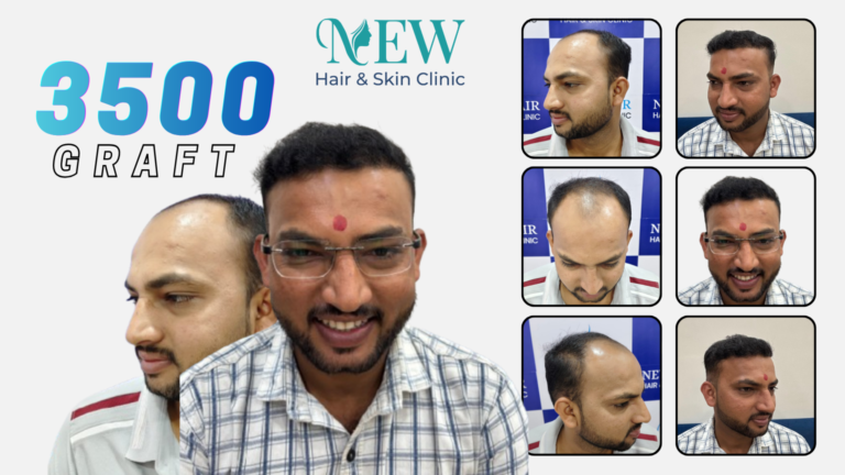 Hair Transplant