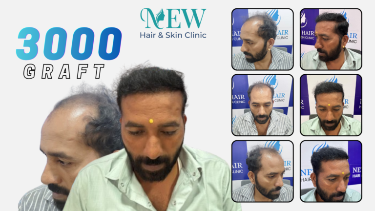 Hair Transplant