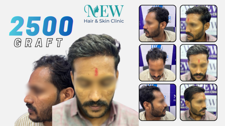Hair Transplant