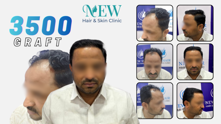 Hair Transplant