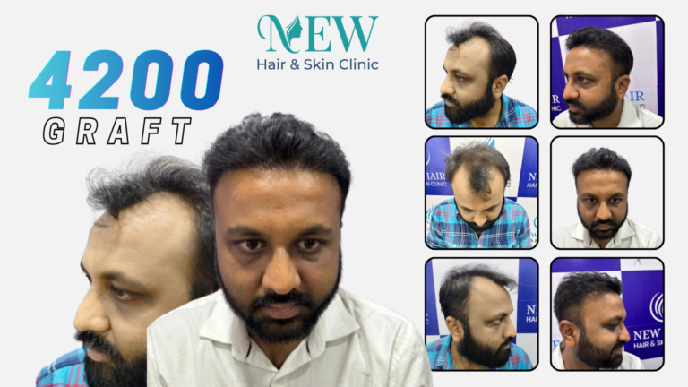Hair Transplant