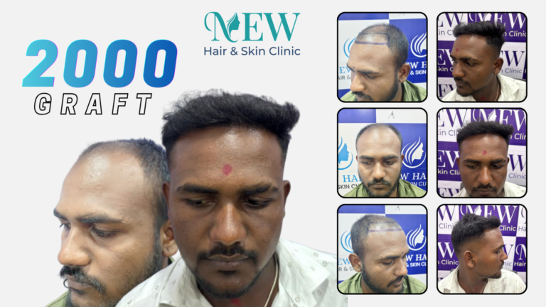 Hair Transplant
