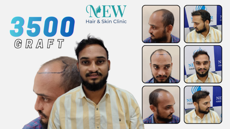 Hair Transplant