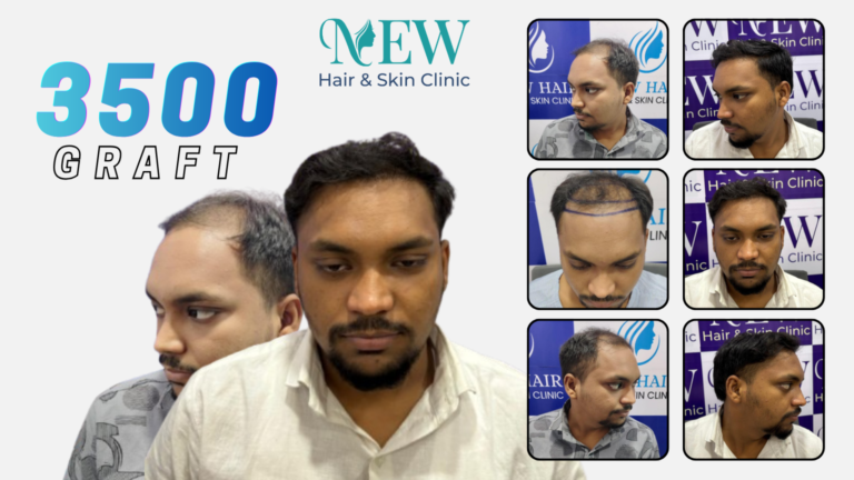 Hair Transplant