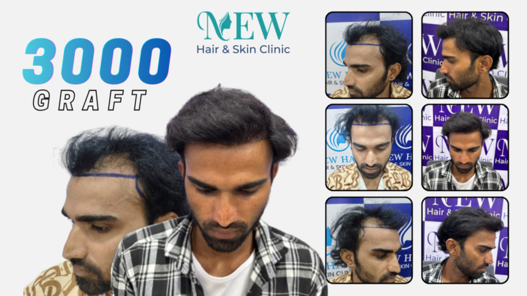 hair transplant