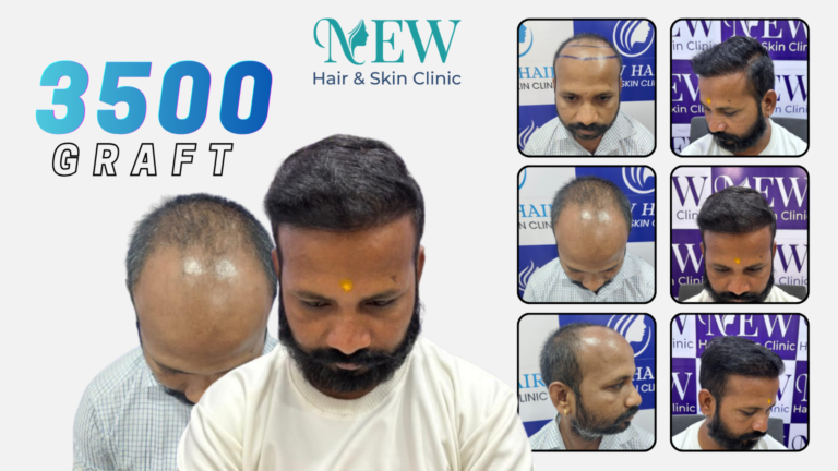 Hair Transplant