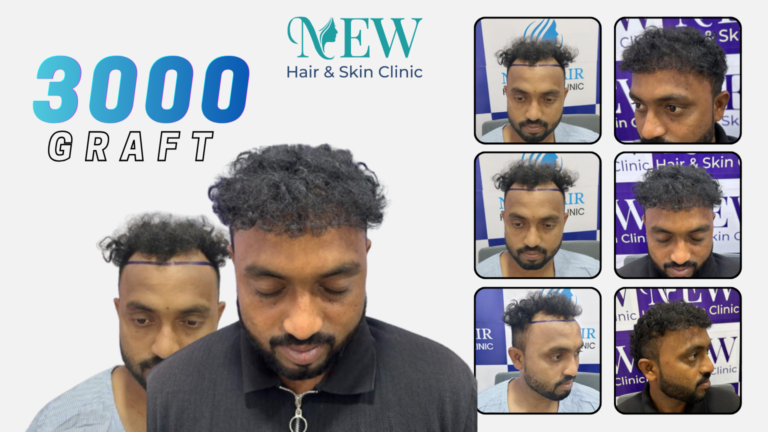 Hair Transplant