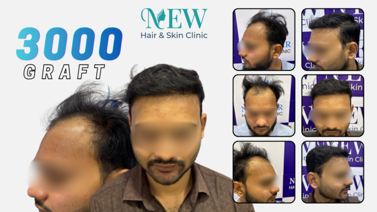 hair transplant in pune