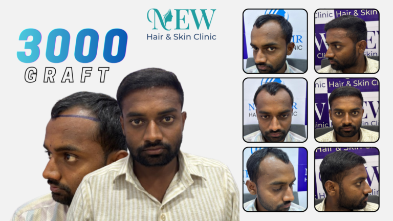hair transplant in pune