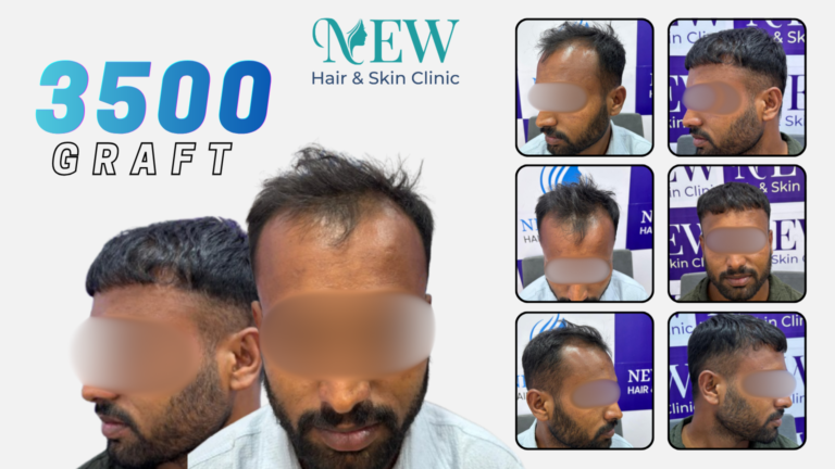 hair transplant in pune