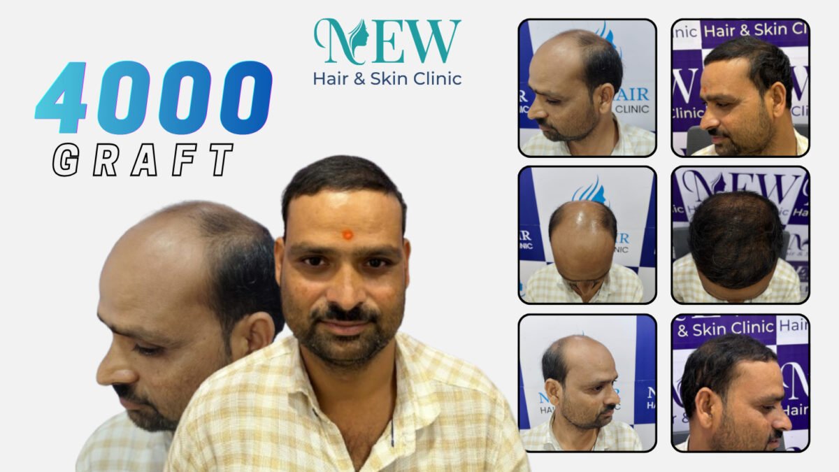 3500 graft hair transplant result with before and after views