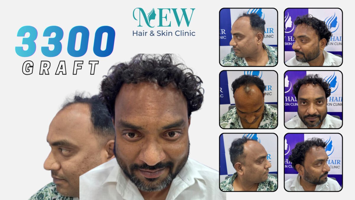 3300 graft hair transplant result showing frontal hairline restoration