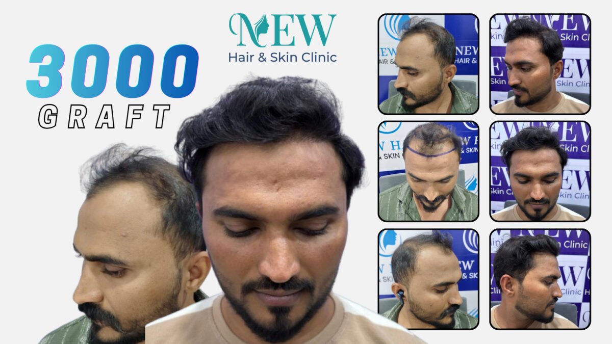 3000 graft hair transplant result with frontal and side views